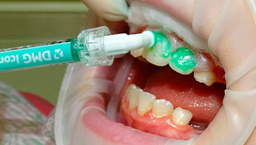 Восстановление эмали зубов инфильтрационным методом Icon | Клиника CONFIDENT в VEGAS МКАД Мякинино