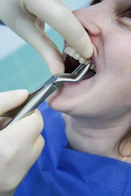 Удаление зуба мудрости | стоматология CONFIDENT